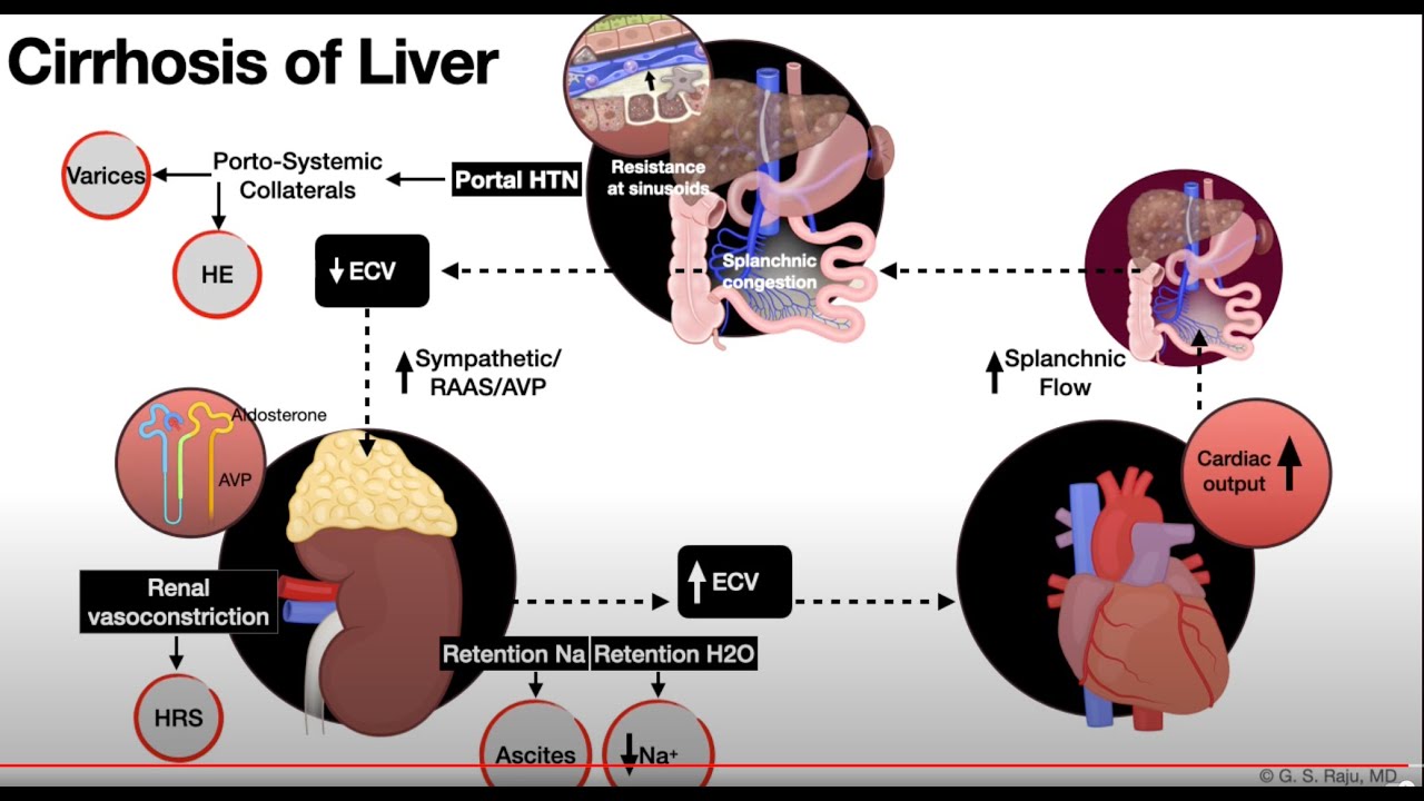 Liver-Cirrhosis-Ascites-1c-Pathophysiology