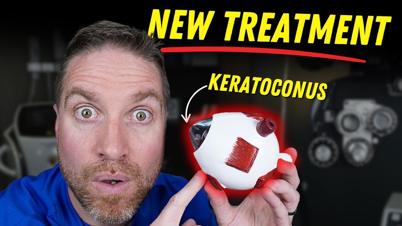 Best Keratoconus Treatment (New and Current!)