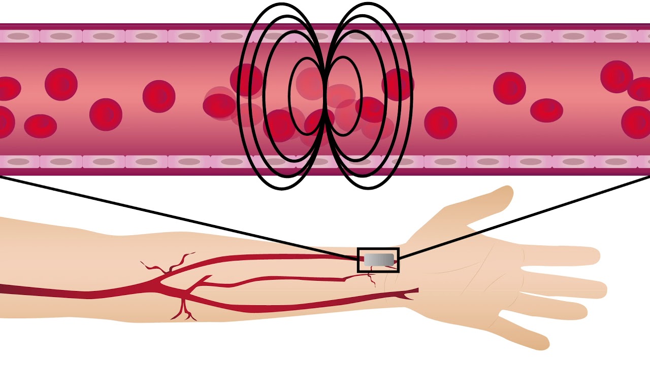 A new method for tracking endothelial dysfunction and heart disease risk in patients with diabetes