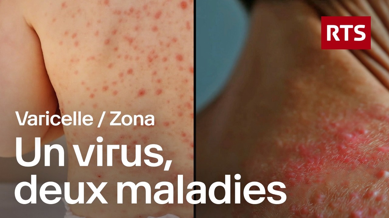 Zona : quand un virus d’enfance se réveille à l’âge adulte | RTS