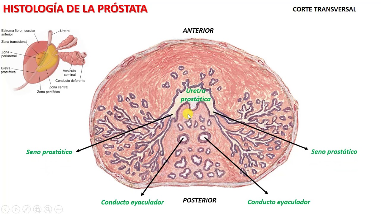 Histología de la Próstata (ver descrip*ción)