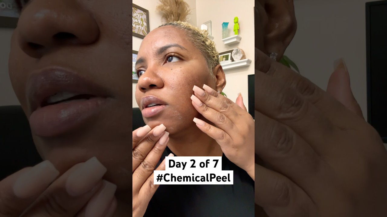 Chemical Peel Season Day 2 ‼️ #acne #facials #pimple #blackheads #laserhairremoval #treatments