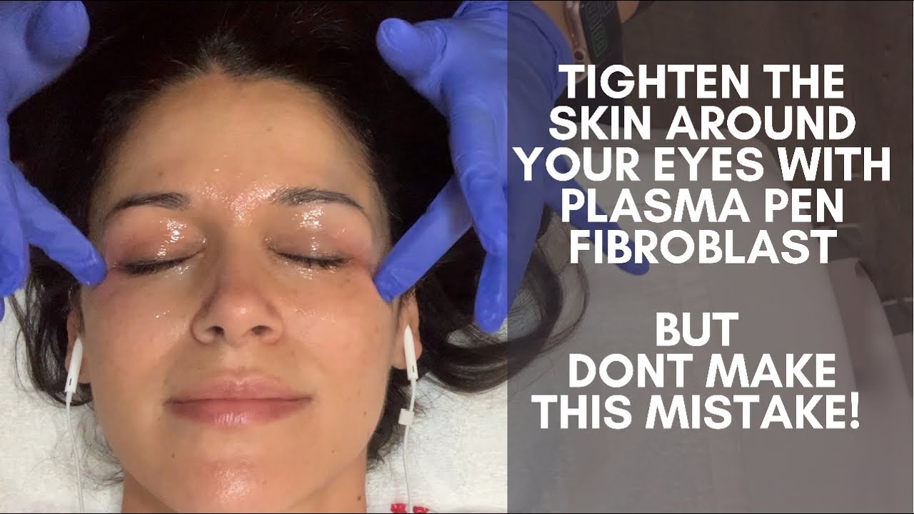 Plasma Pen Fibroblast treatment to tighten skin around my eyes. The huge mistake I almost made!