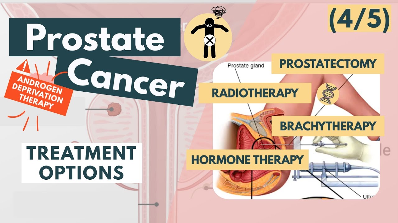 Treatment of prostate cancer | Overview for Med Students | Urology