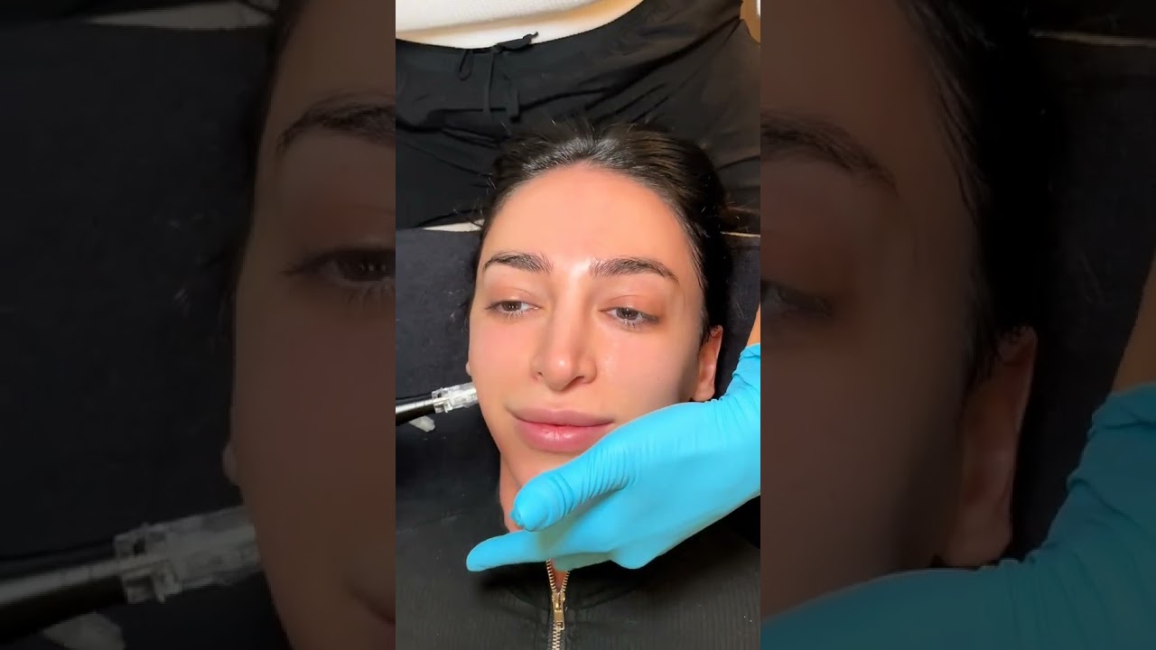 What is PDRN Micro-needling and what are the benefits? 🤭