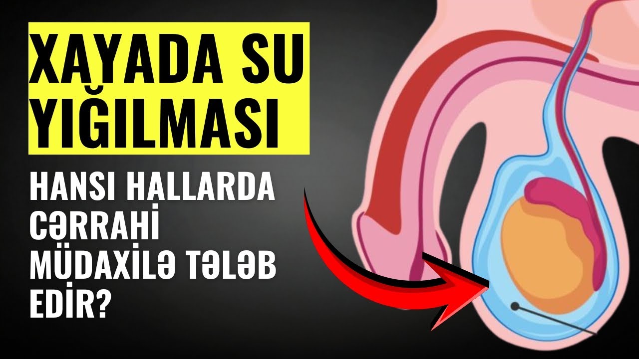 Hidrosel əməliyyatsız keçə bilər, yoxsa mütləq əməliyyat lazımdır?