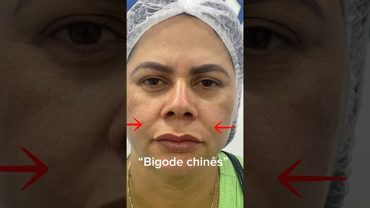 Preenchimento no bigode chinês” 