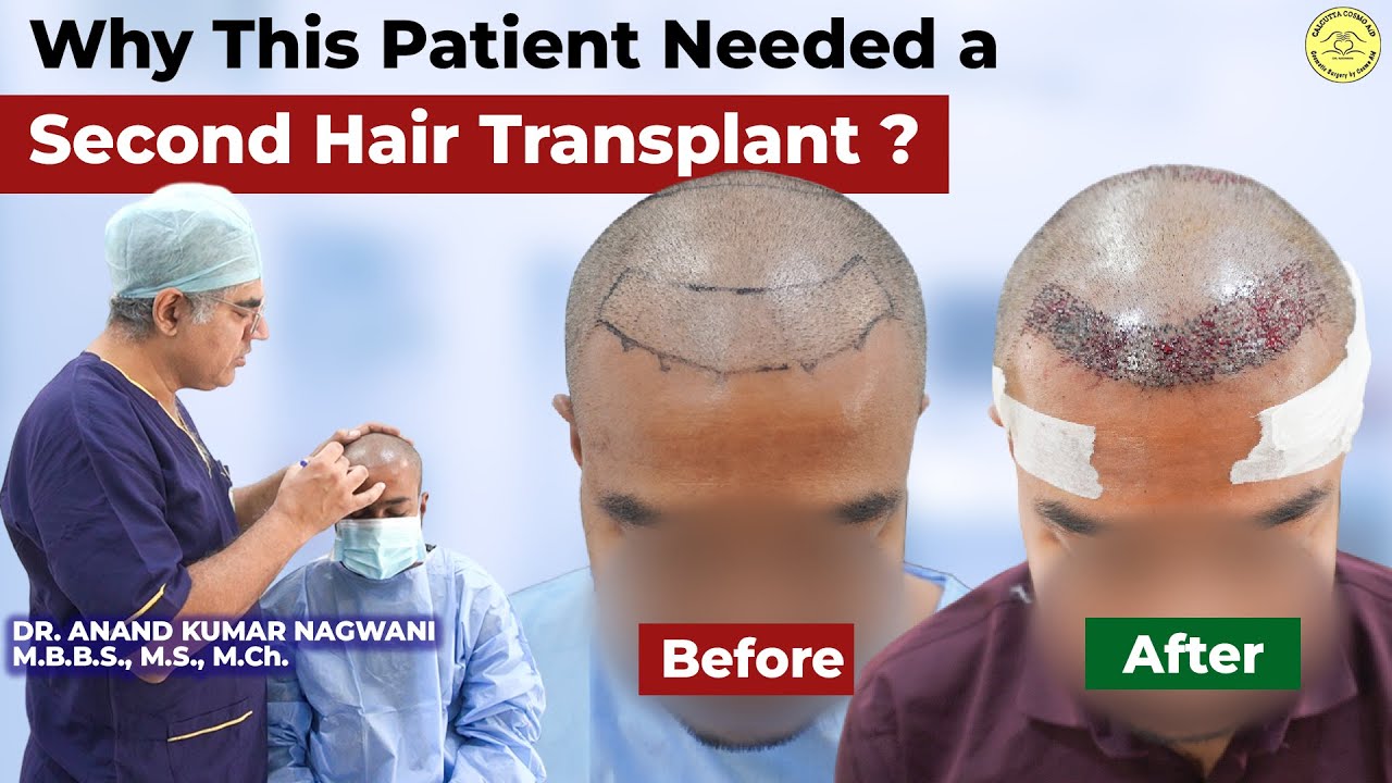 Why This Patient Needed a Second Hair Transplant ? | Best FUE hair transplant in Kolkata