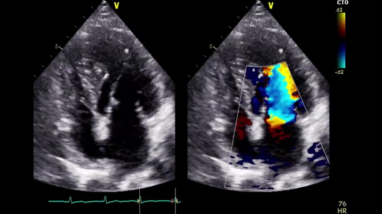Scary case of myocardial perfusion imaging
