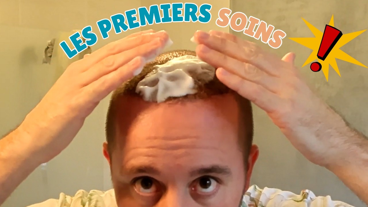 Greffe de cheveux 9 jours après (routine de soins et évolution réelle)