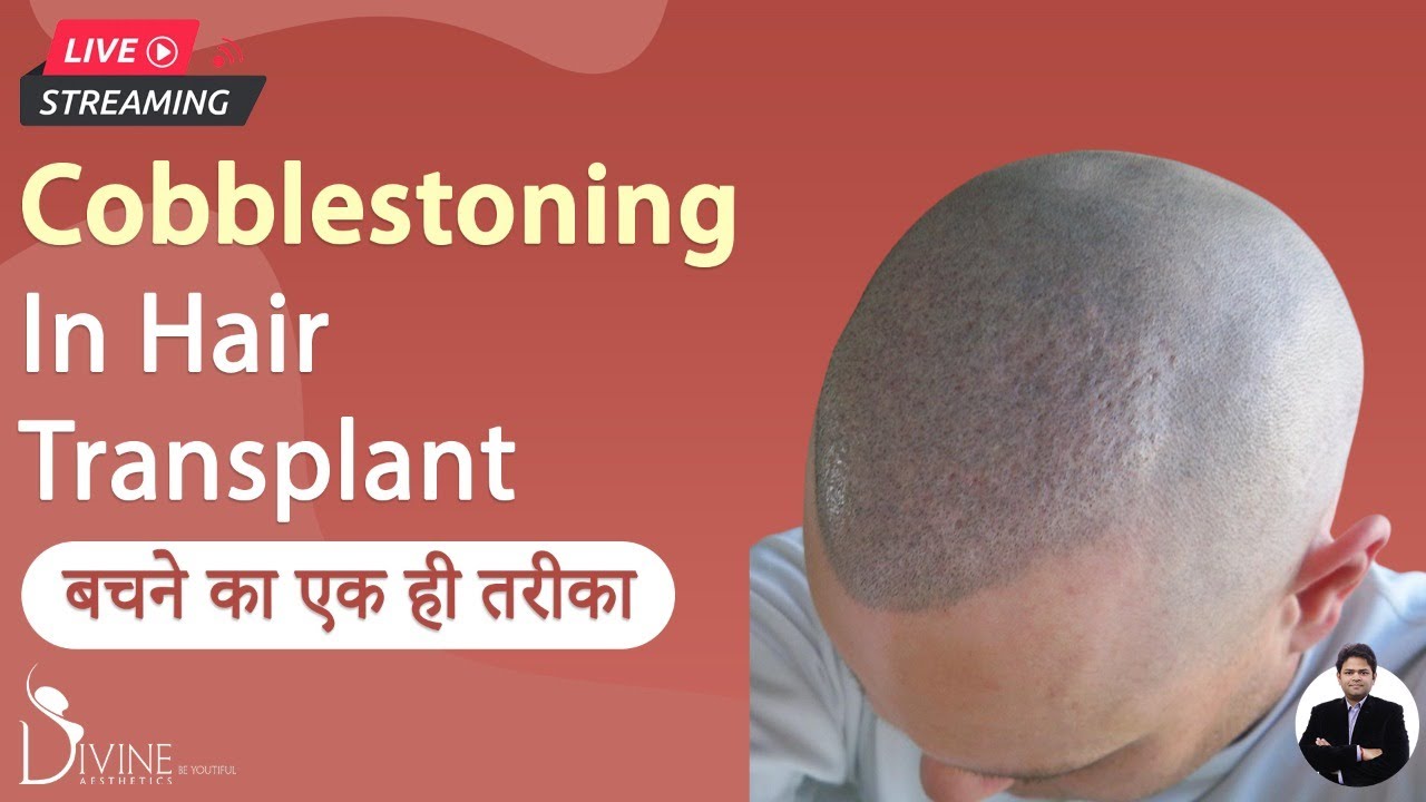 Cobblestoning In Hair Transplant | बचने का एक ही तरीका