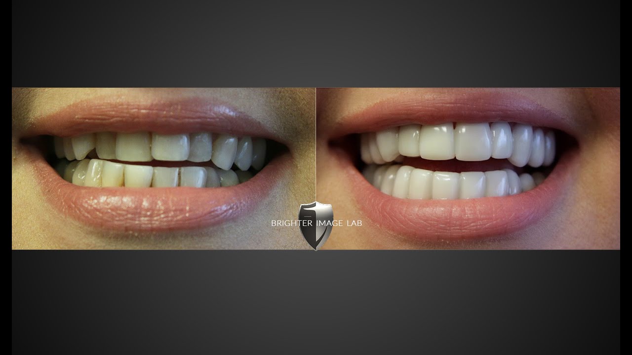 Instasmile v Brighter Image Lab Smile Makeover Обзор! ВИДЕТЬ, кого вы верите?