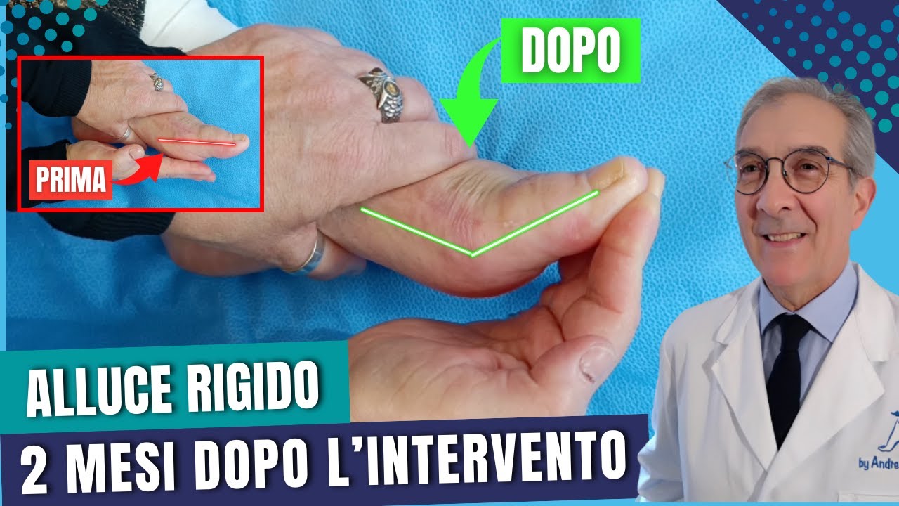 ALLUCE RIGIDO 2 MESI DOPO L'INTERVENTO | Dott. Andrea Scala
