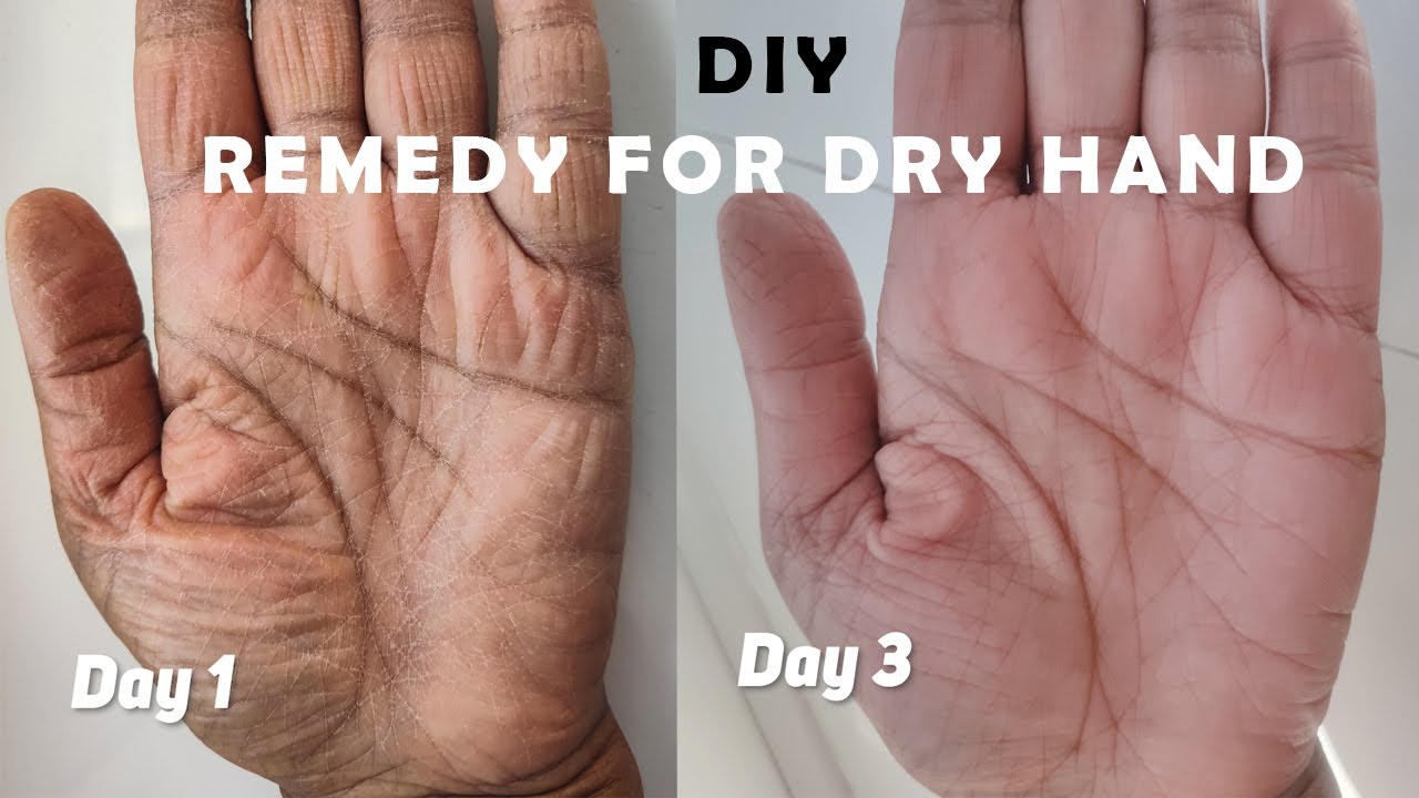 Home remedy for dry hands - dry skin removal | easy home remedy for dry cracked hands