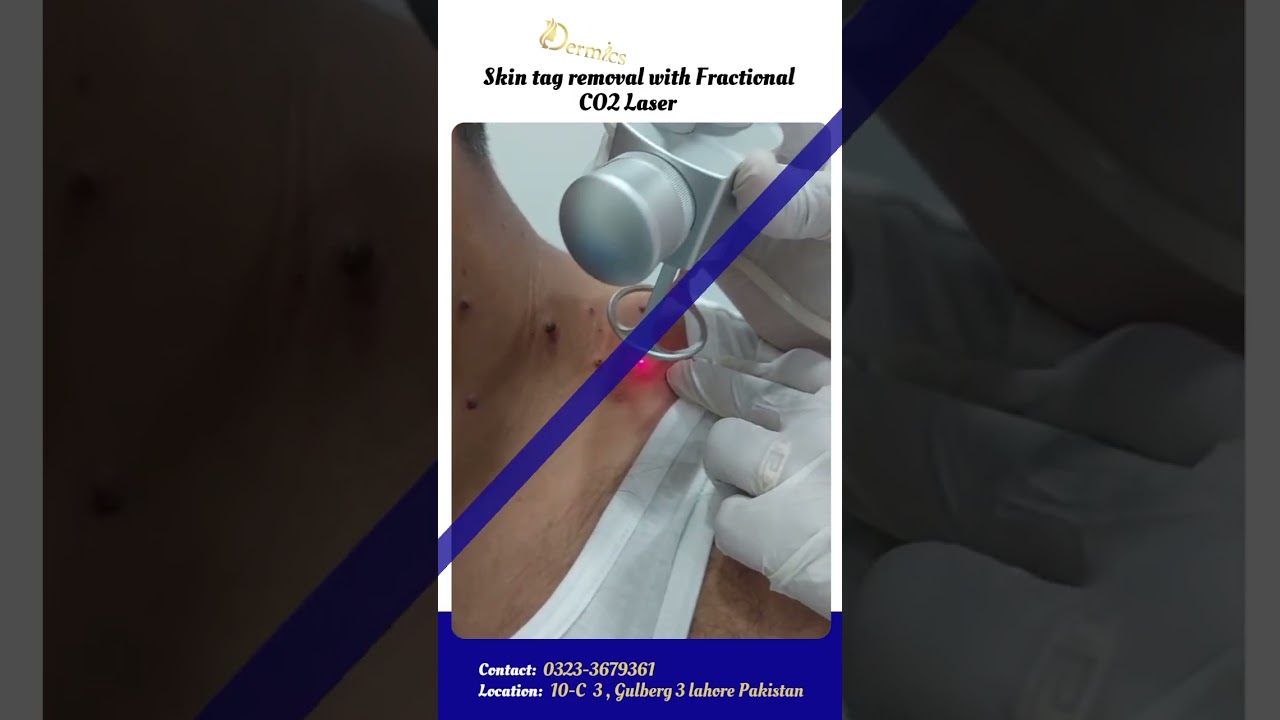 Skin Tag Removal with Fractional CO2 Laser | Dermics  #glowingskin #lasertreatment