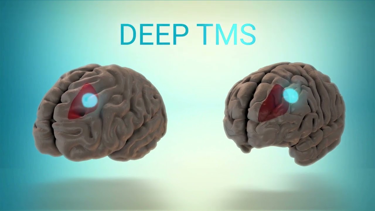 TMS Therapy & deep TMS explained by Dr. Feifel