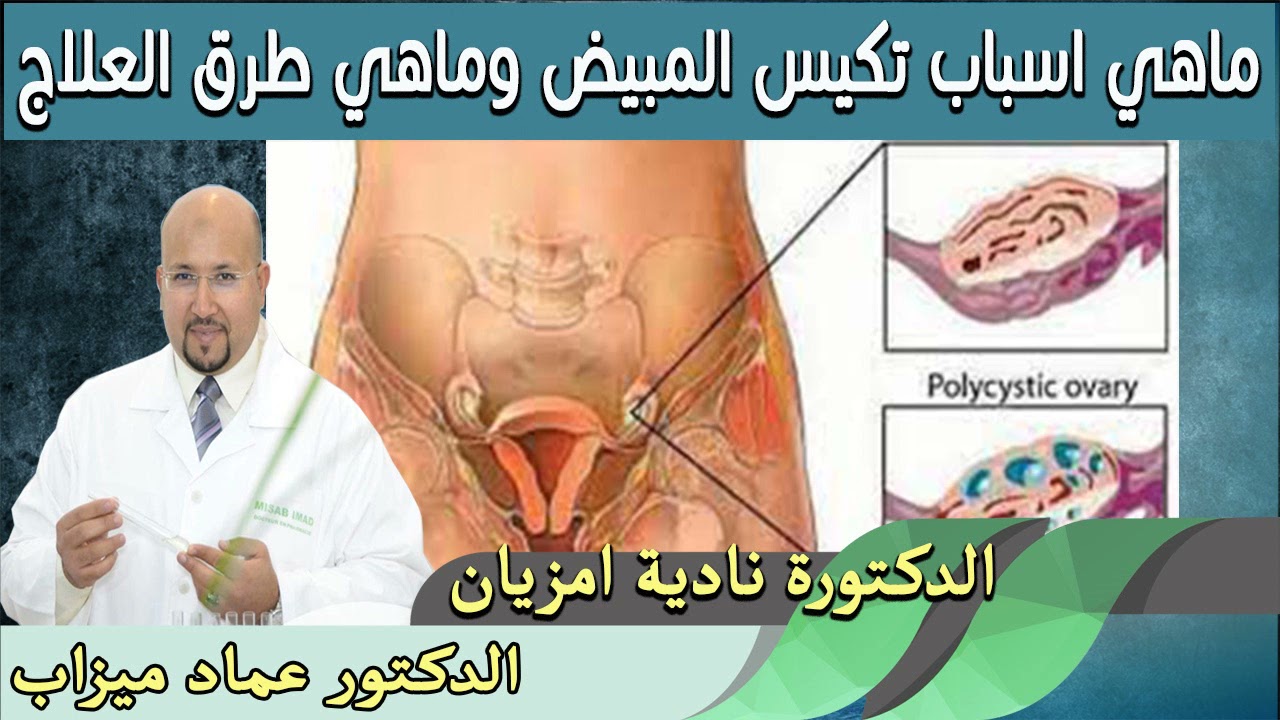 ماهي اسباب تكيس المبيض وماهي طرق العلاج من الطب والطبيعة الدكتورة نادية امزيان والدكتور عماد ميزاب