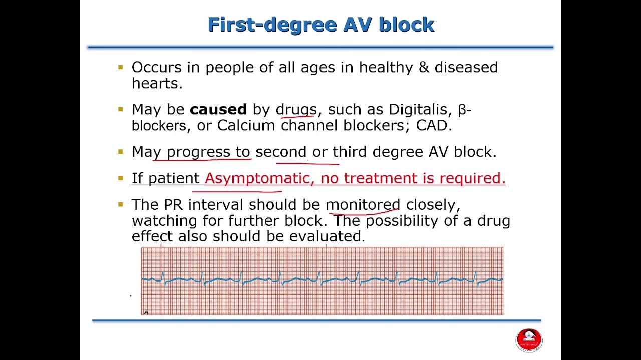 Critical Care Nursing - ECG Part 3: Atrioventricular Blocks