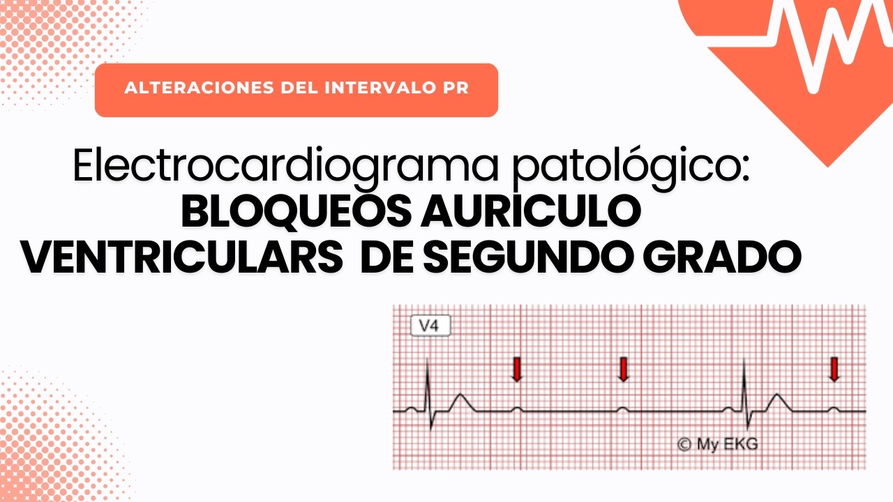 Electrocardiograma Patológico: BLOQUEOS AV DE SEGUNDO GRADO (Mobitz I y II)