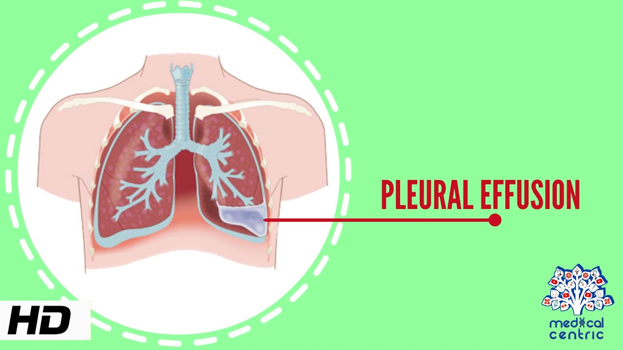 Pleural Effusion, Causes, Signs and Symptoms, Diagnosis and Treatment.