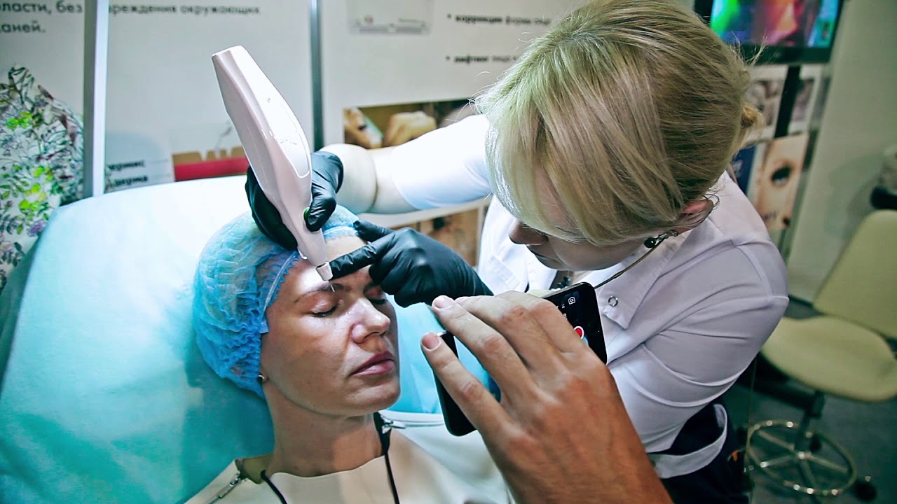 Plexr Non-Surgical Blepharoplasty performed by Dr. Aliautsina Kuzichava Marcou
