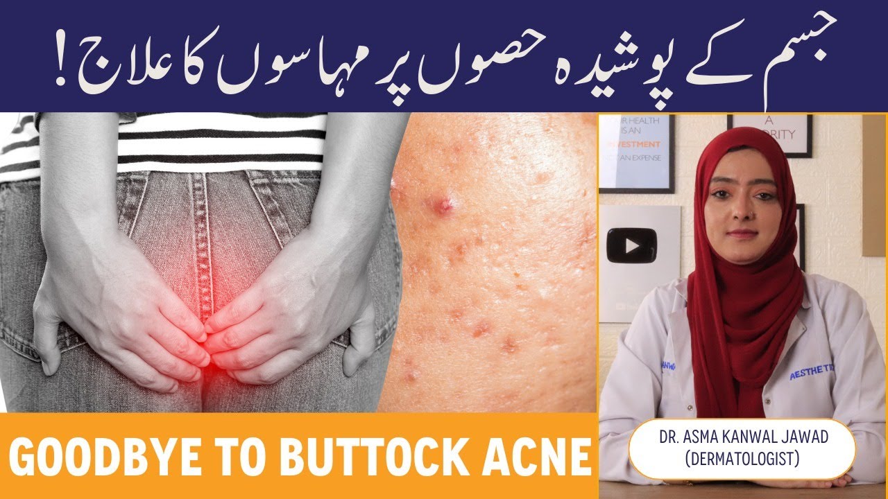 How To Treat Buttock Acne - Kulho Par Dano Ka Ilaj - Kali Baghlon Ki Wajah - Hips Par Pimple Ka Ilaj