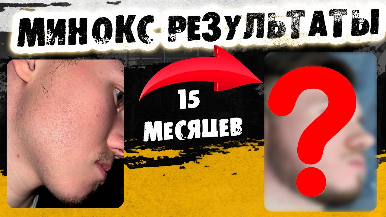 15 месяцев на курсе Минокса / как запустить рост бороды? / Выпуск 35 / Андрей борода