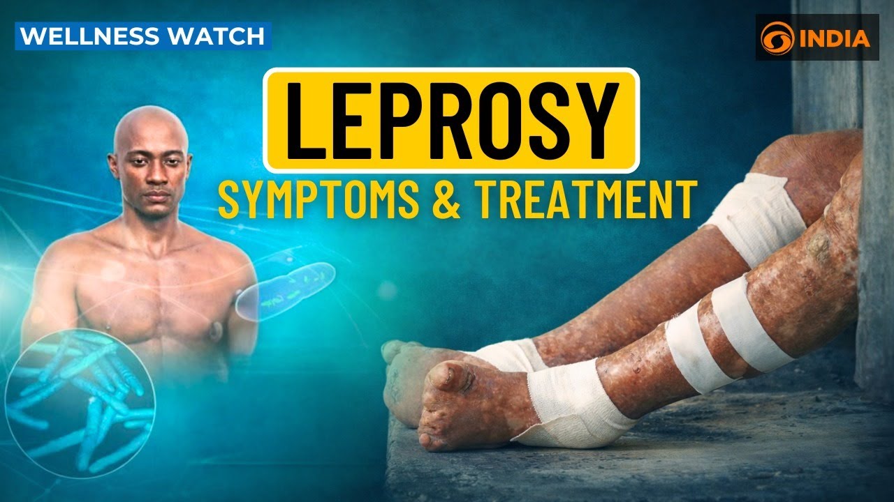 Leprosy: Symptoms & Treatment | Wellness Watch