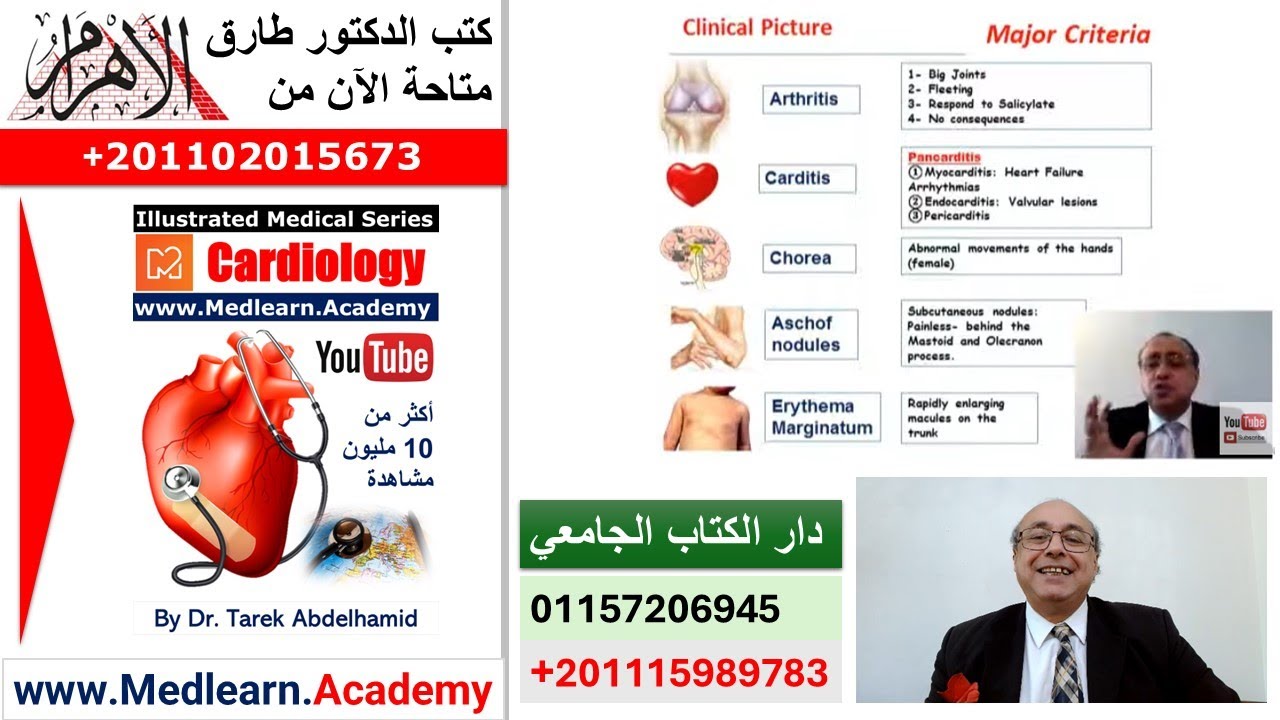Rheumatic Fever    #usmle #internal_medicine #cme #medicaleducation #ecg  #محاضرات_باطنة #medical