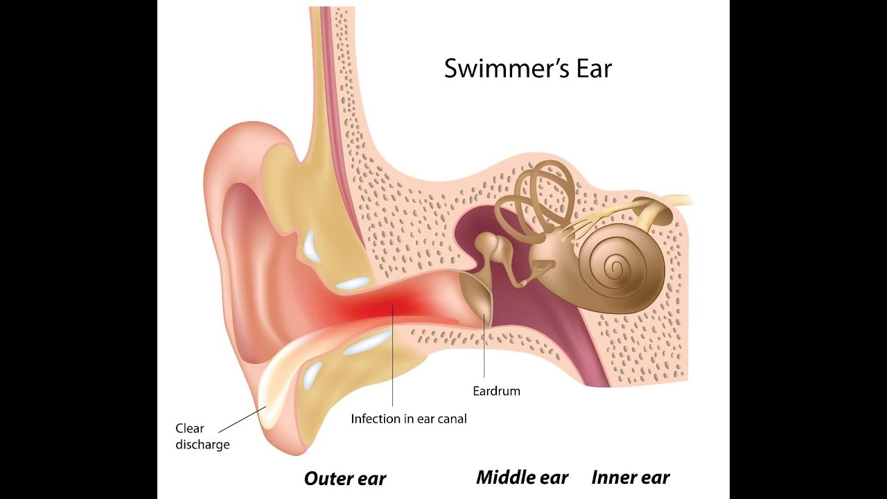 Otitis Externa