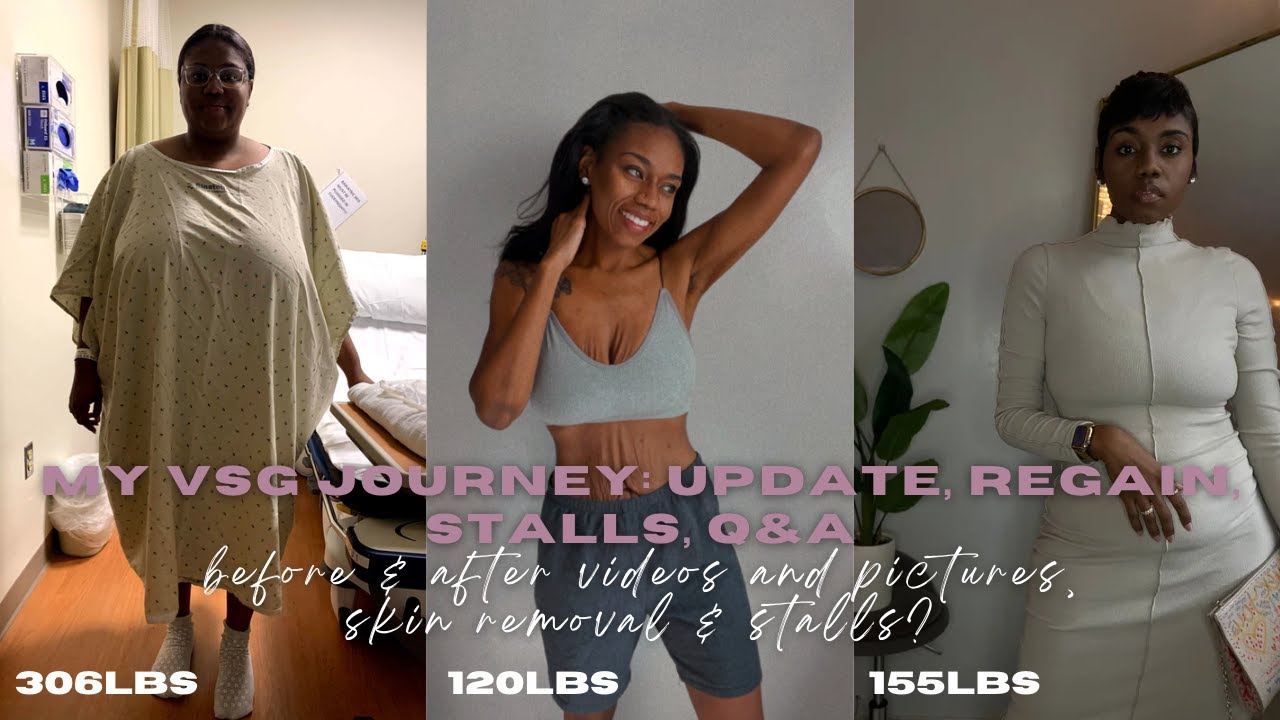 My VSG Journey, 3 Years Post Op Update, BEFORE & AFTER Videos and Pictures, 185 Pounds Down In Total