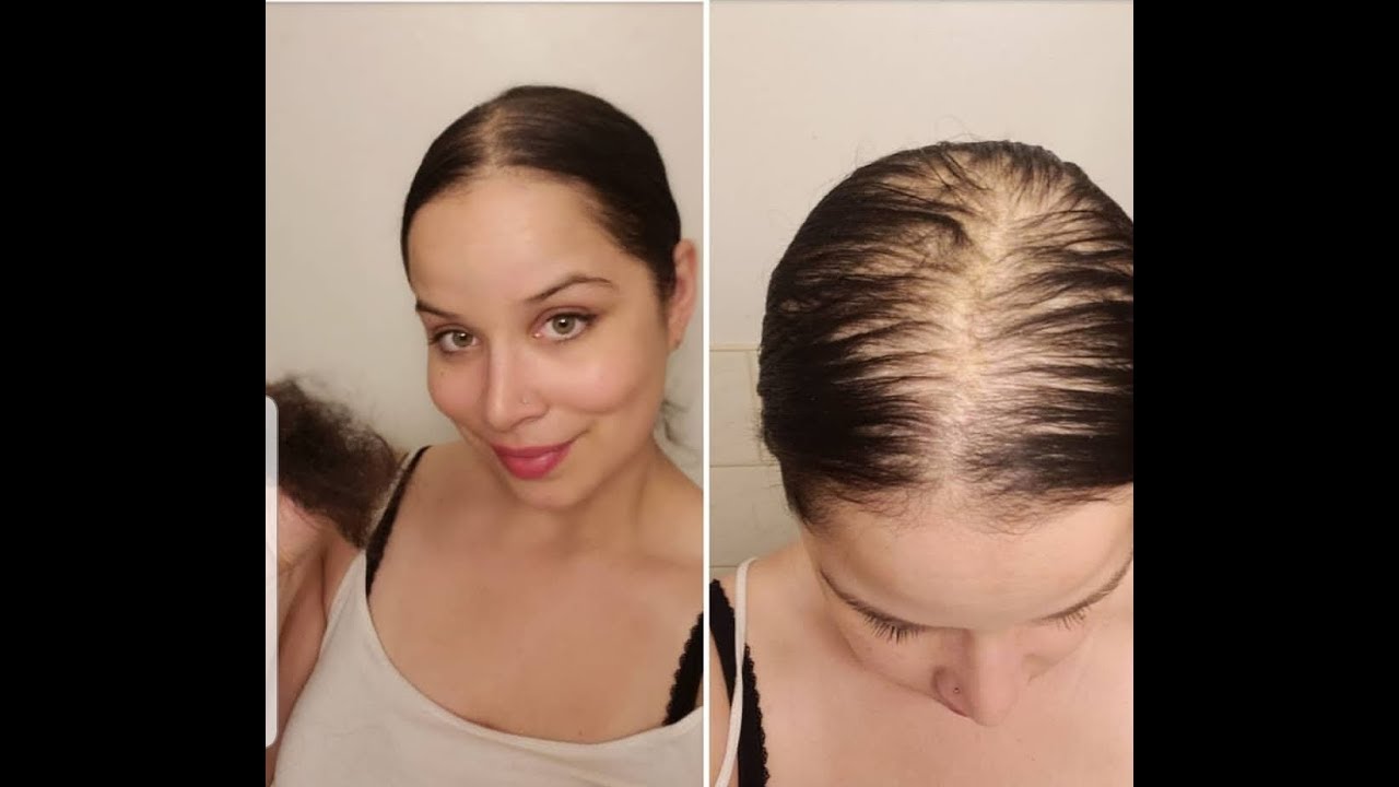 My Hairloss Journey