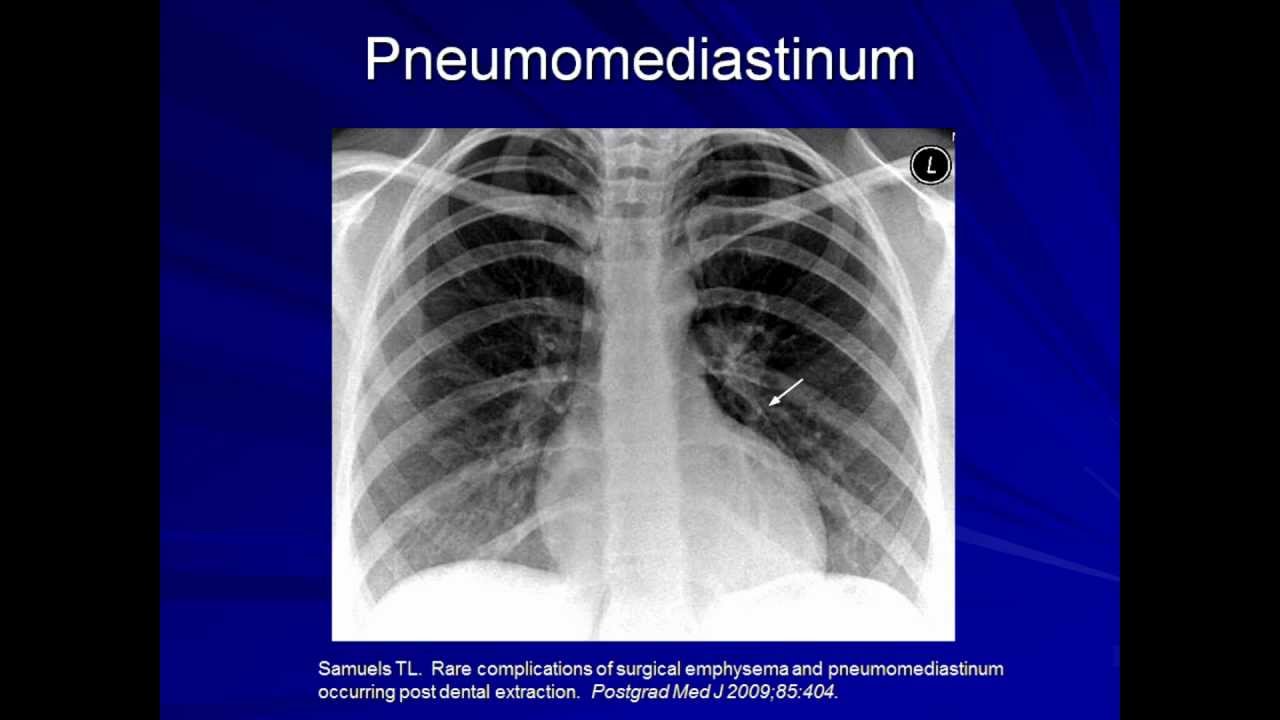 Lung Protective Ventilation (Mechanical Ventilation - Lecture 9)