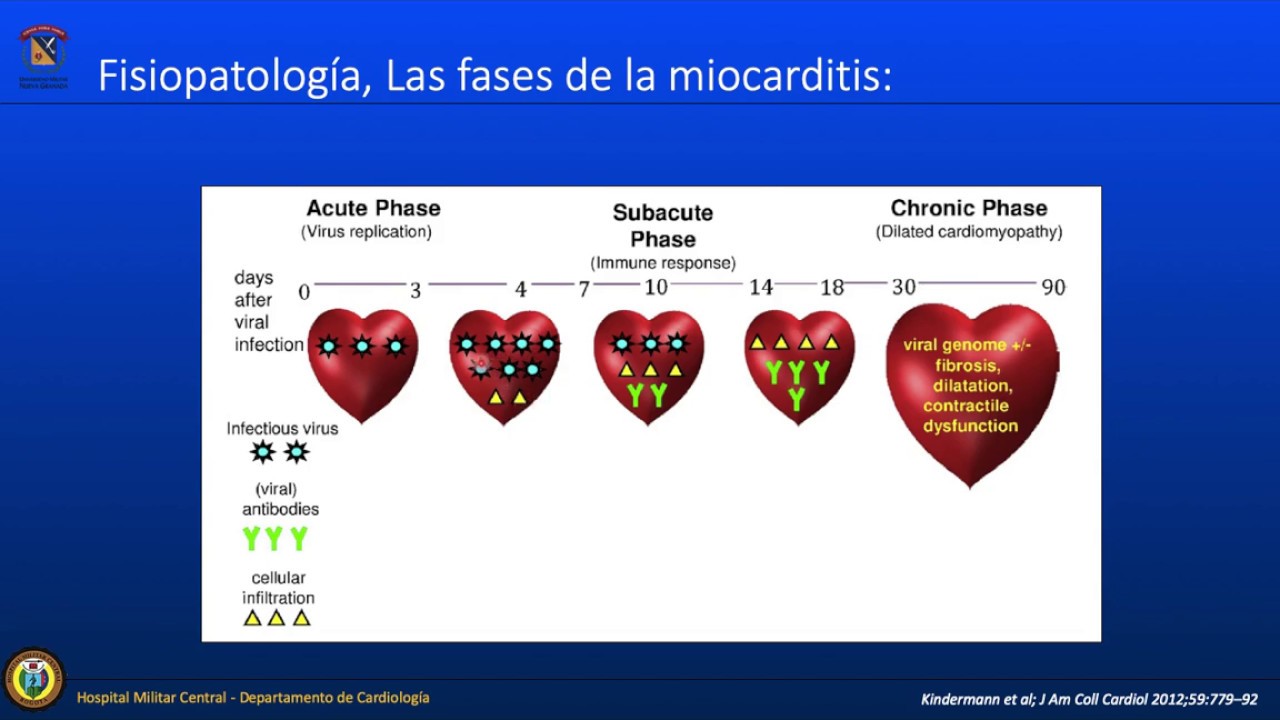 Miocarditis Aguda - enfoque urgencias