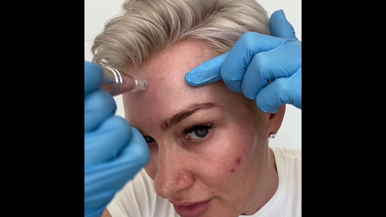 NanoNeedling treatment for Estheticians - MD Needle Pen Micro Needling Pen for Medical Professionals