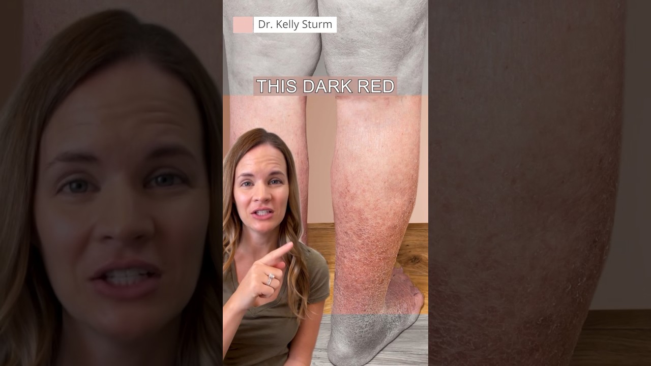 What Causes Leg Discoloration?