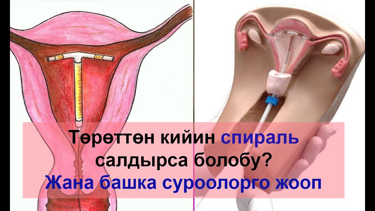 Төрөттөн кийин спираль салдырса болобу? Жана башка суроолорго жооп