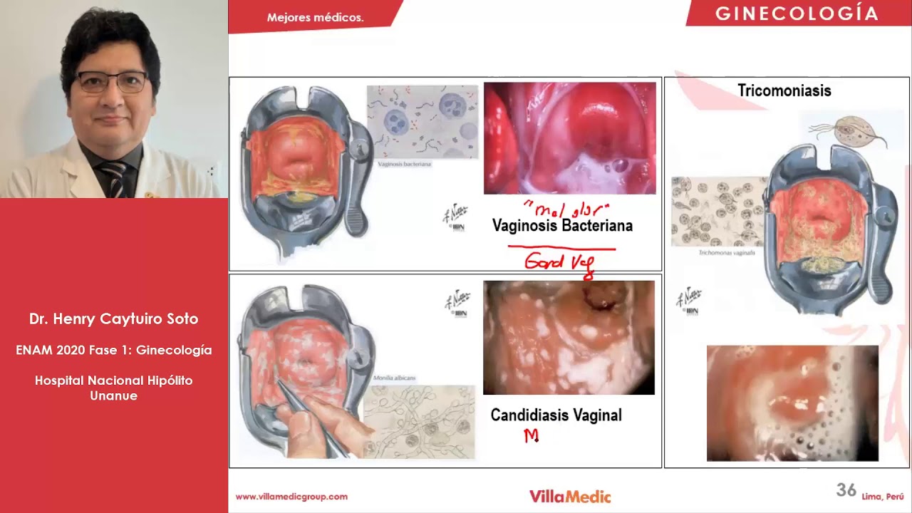 GINECO | Vulvovaginitis - ENAM 2021