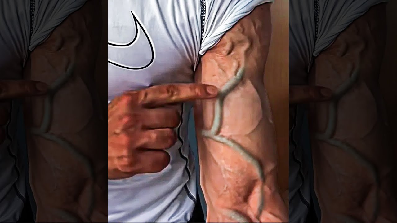 Bro Destroyed His Arm...