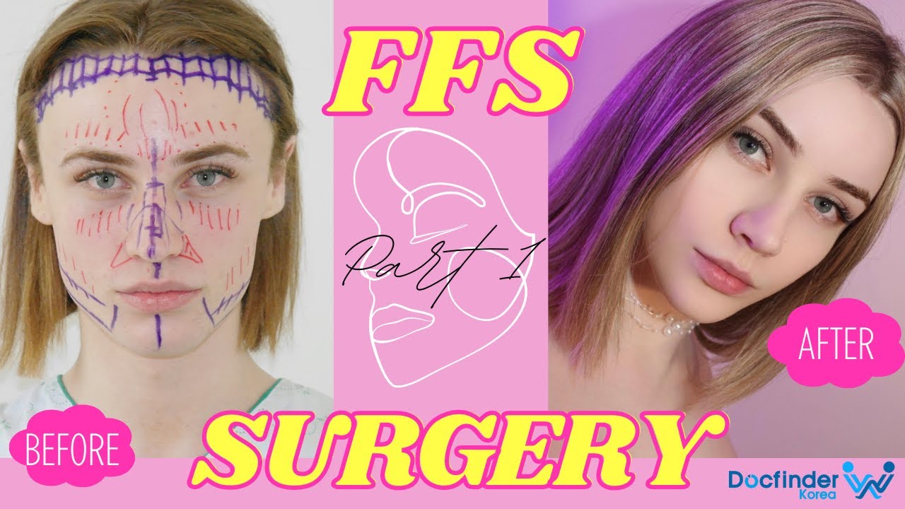 How to not FAIL your Facial Feminization Surgery in Korea Part 1