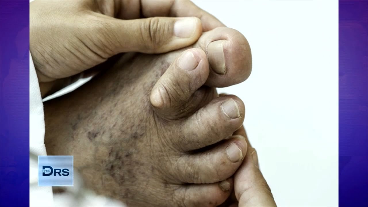 What Are Hammertoes and Why Are They So Painful?