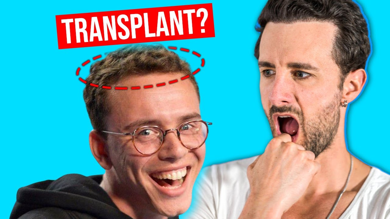 Logic got a Hair Transplant? 😲
