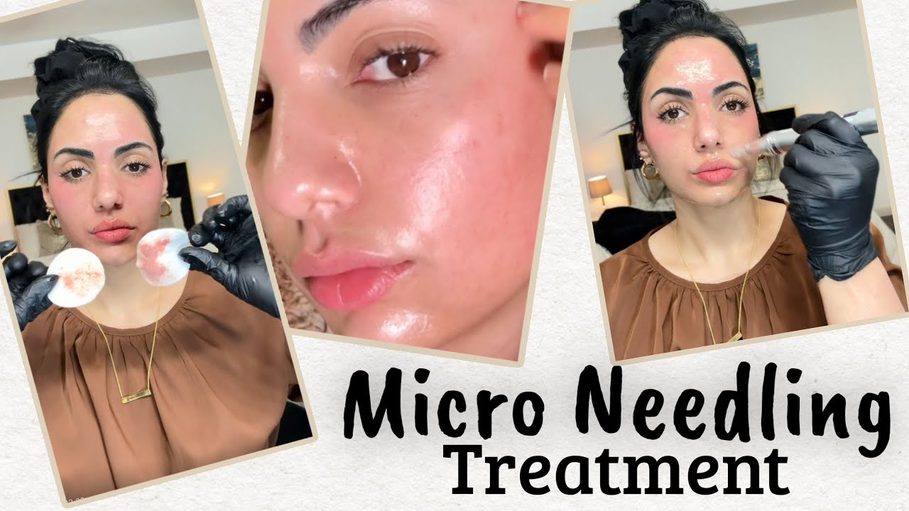 At-Home Microneedling Treatment – Full Guide & Details.❤️✨