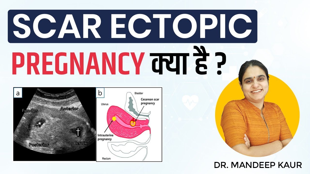 Scar Ectopic Pregnancy in Hindi, Types, Treatment, COS, Caesarean, Crossover sign, in MRI Radiology