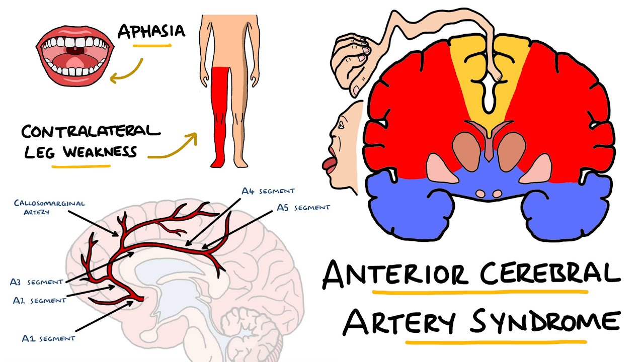 Anterior Cerebral Artery Stroke Syndrome -  ACA Stroke Syndrome | Stroke Syndromes