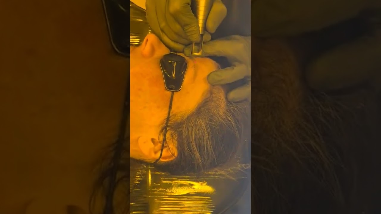 Despigmentação de Sobrancelha laranja que fez diversas sessões de laser, aqui nos resolvemos