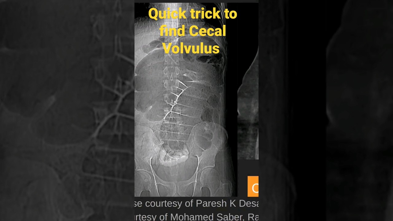 cecal volvulus