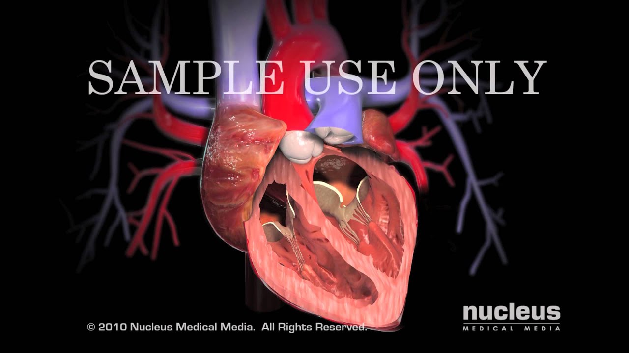 Aortic Valve Replacement