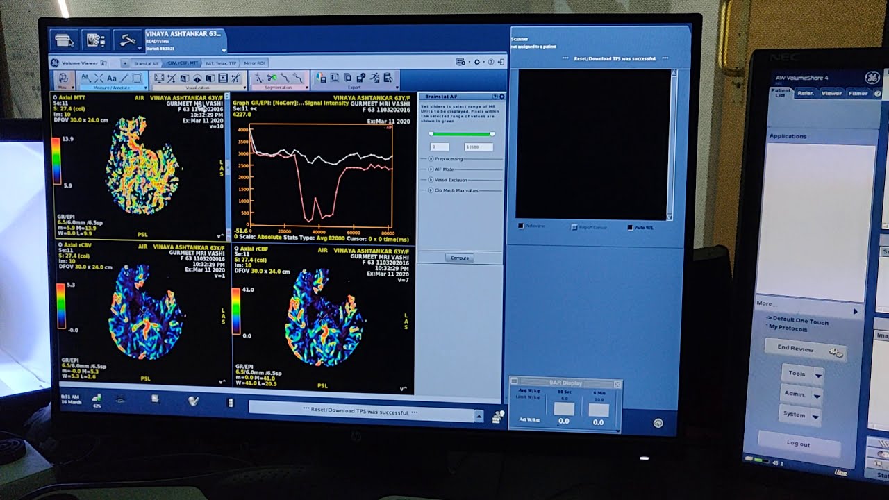 MRI brain perfusion post processing