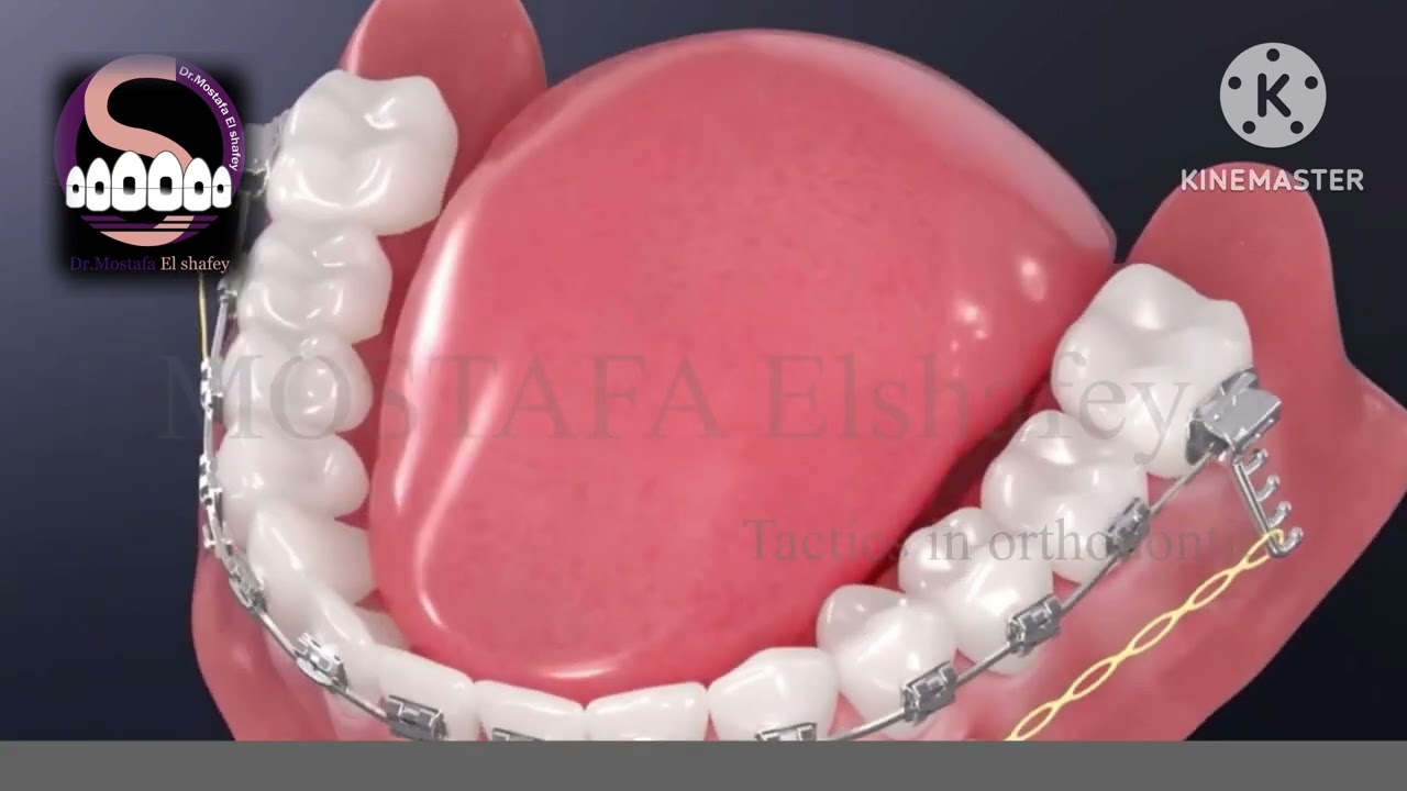 M-P TUBE.      #Orthodontic #SmileJourney #OrthoLove #ConfidenceBoost #NewSmileComingSoon #Team